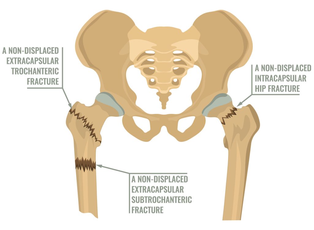 Types of different hip fracture