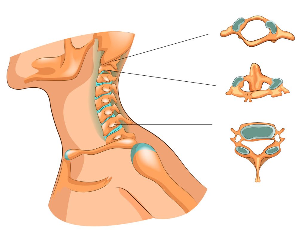 Osteoarthritis of the Neck structure of the cervical vertebrae
