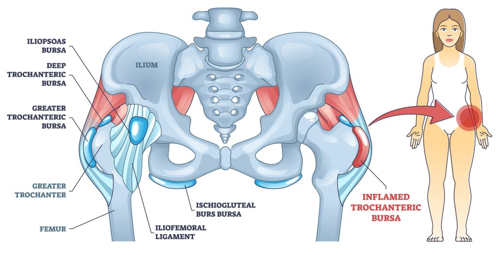 treatment for Trochanteric bursitis as bursa inflammation located in hip