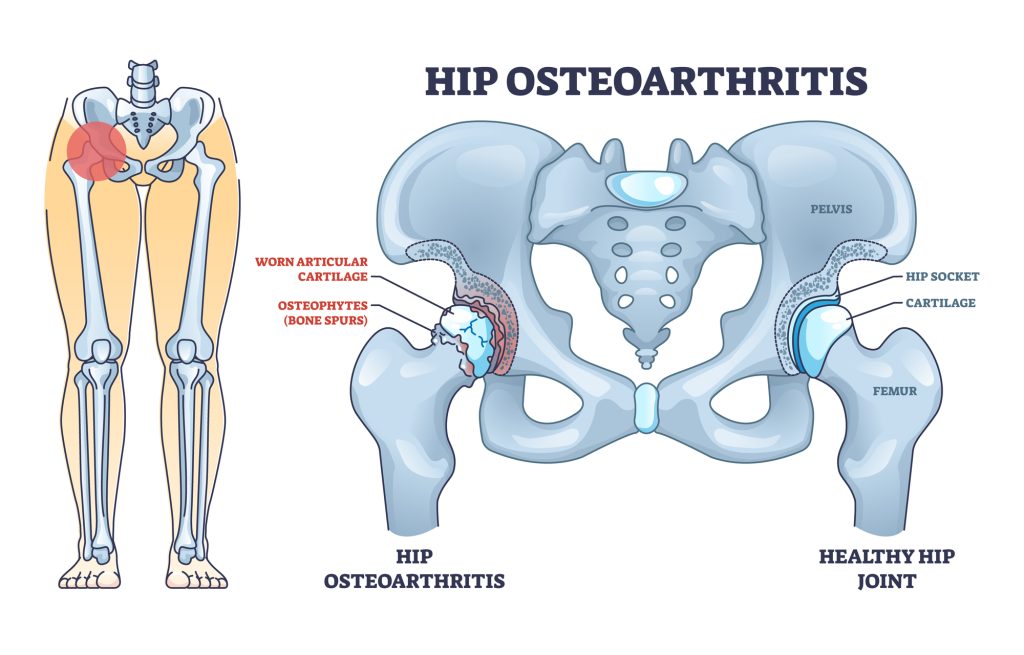 Hip osteoarthritis bone disease osteopaths for Osteoarthritis​