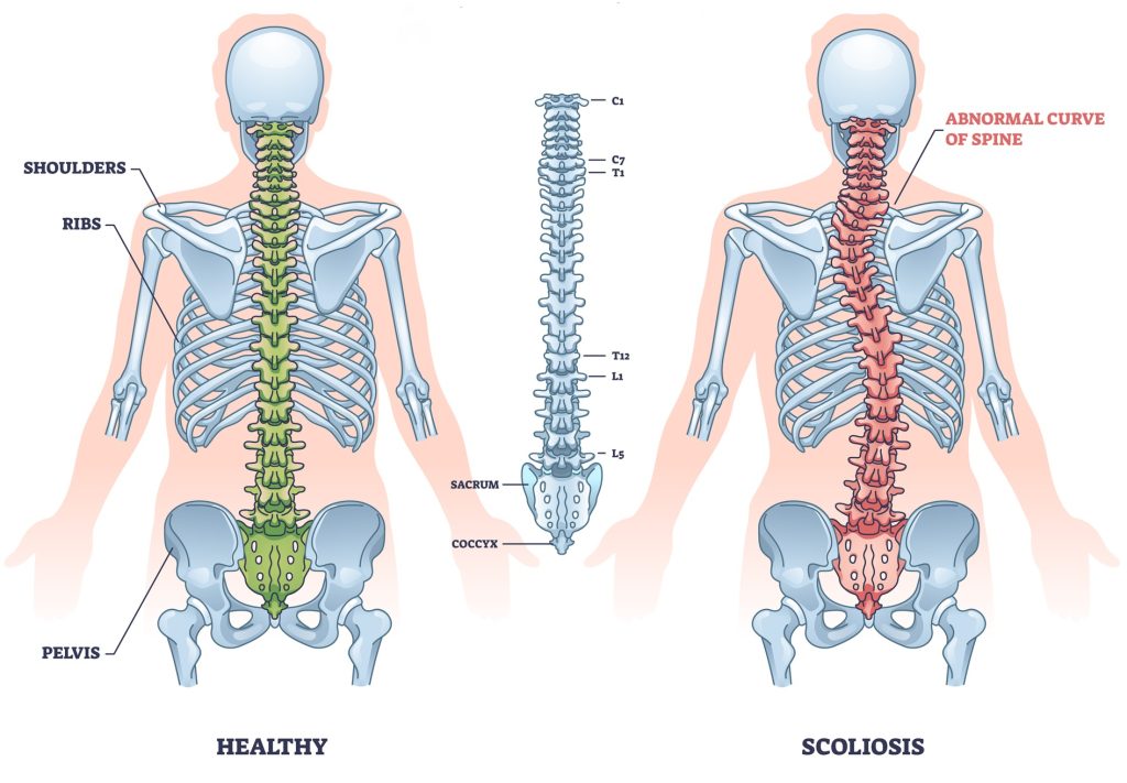 Scoliosis Back Treatment Clinic London