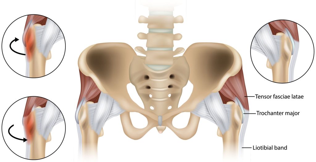 Coxa Saltans or Snapping aka Hip Snapping Hip Syndrome or the dancer hip.