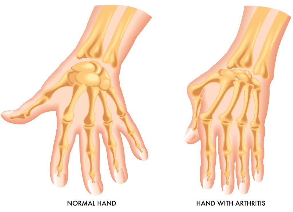 Rheumatoid Arthritis​ treatment - osteopaths for arthritis