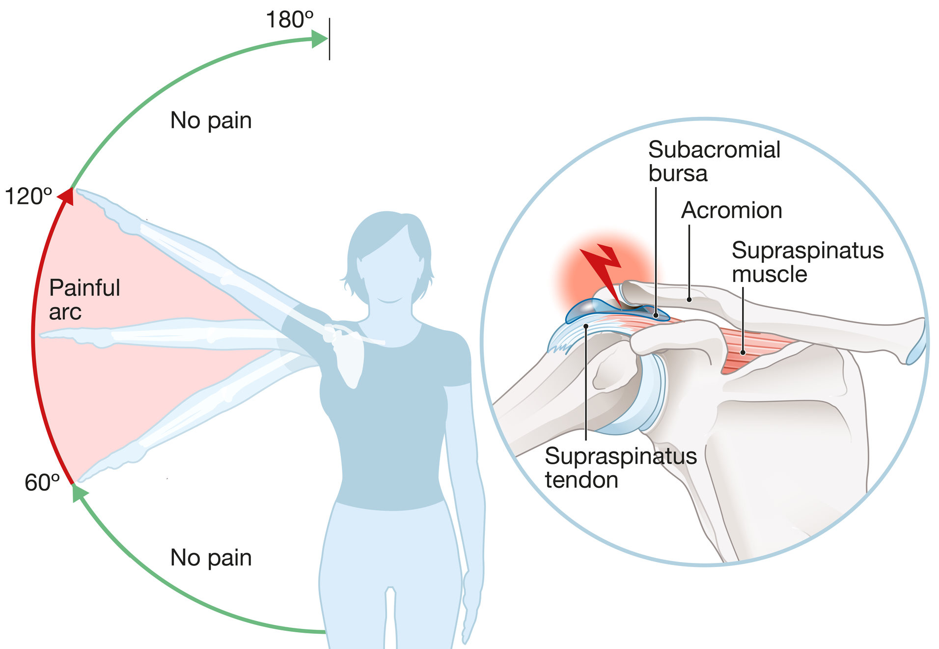 Shoulder Impingement Syndrome​ shoulder pain treatment by osteopaths in london