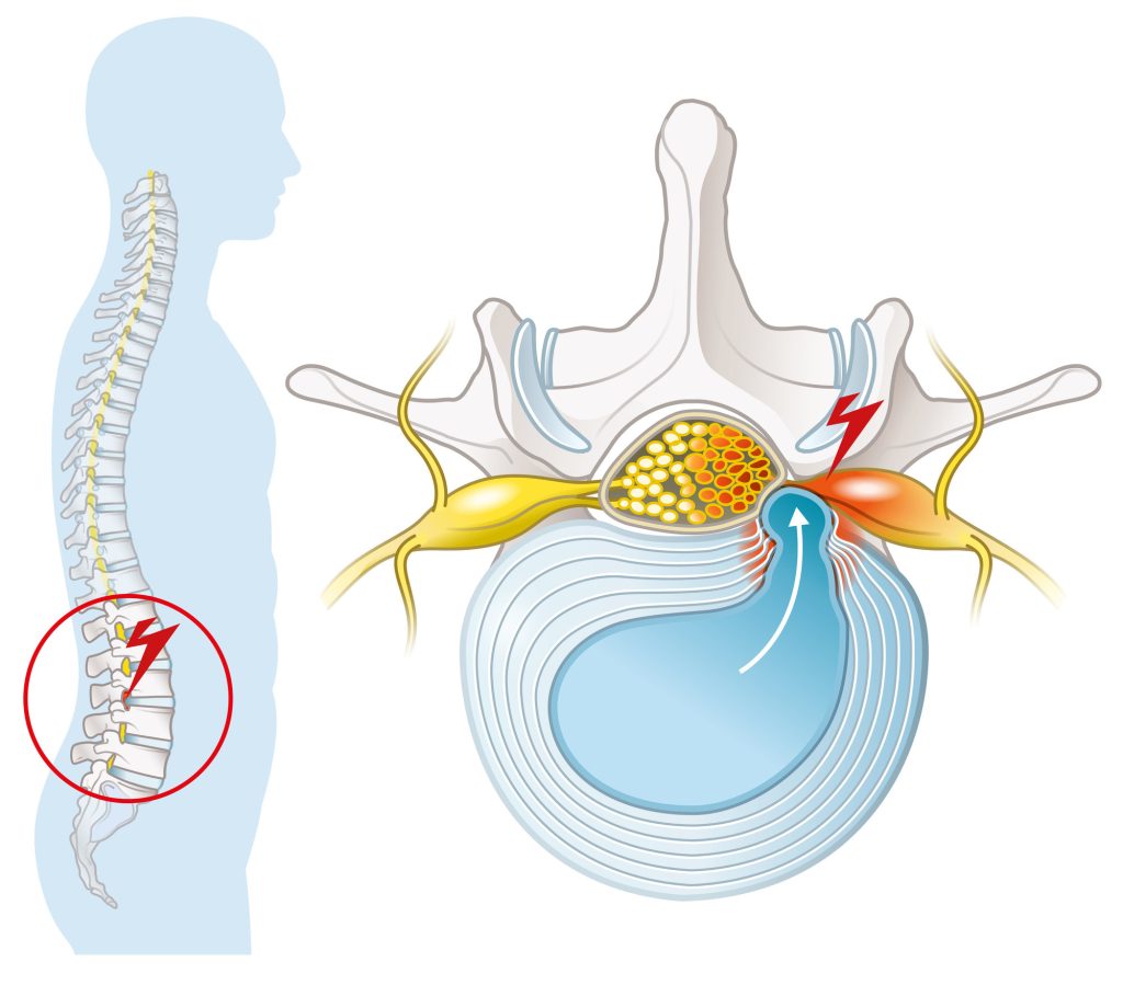Spinal Stenosis & Sciatica​ in London