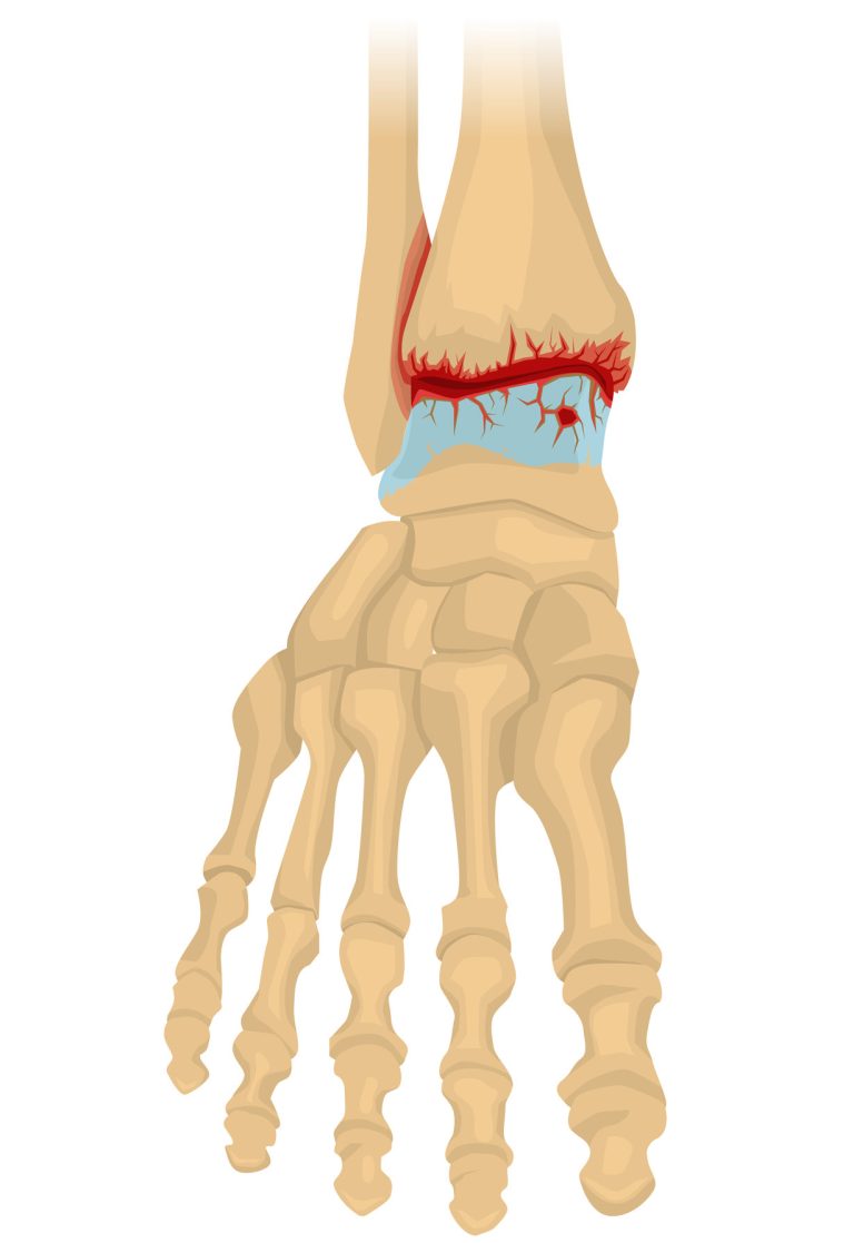 osteoarthritis of the foot arthritis treatment osteopathy clinic London