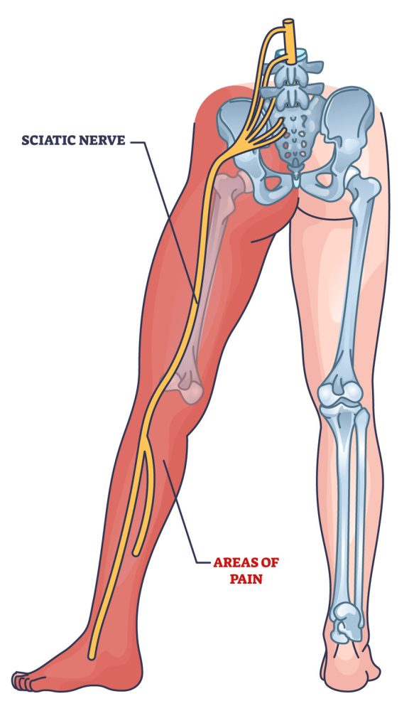 sciatic nerve pain areas diagram