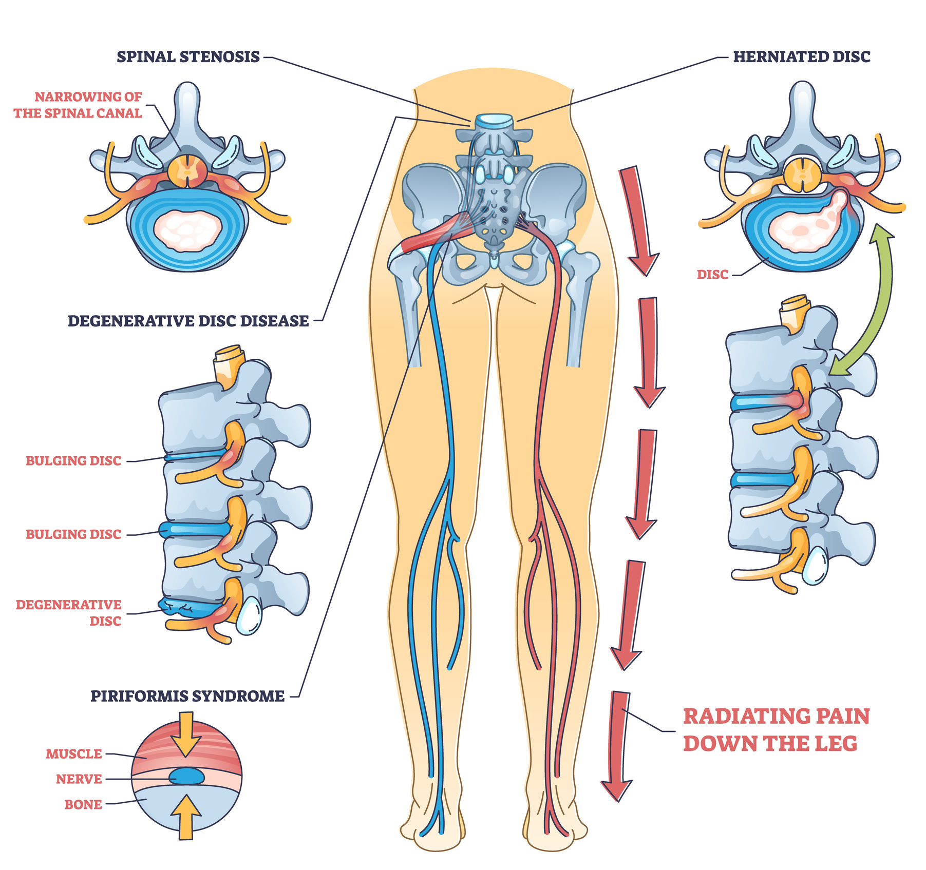 Sciatica pain or nerve weakness as leg lumbar radiculopathy outline diagram