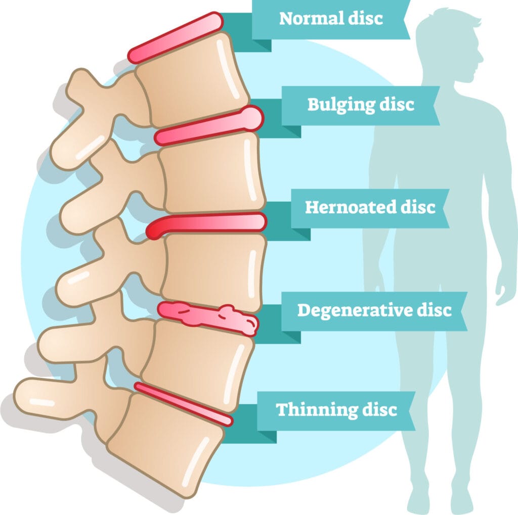 Degenerative Disc Disease Treatment DDD causes benefits