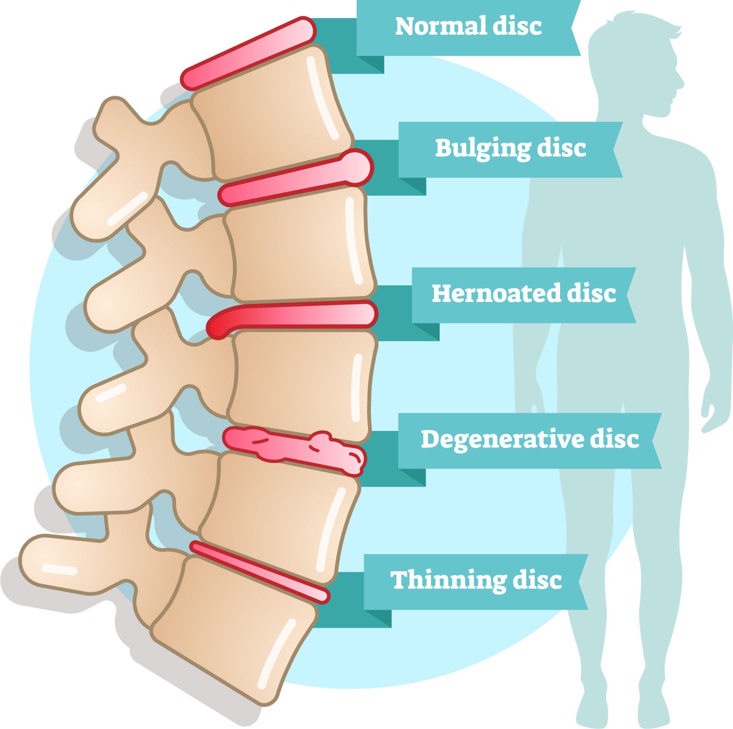 Degenerative Disc Disease Treatment DDD causes benefits