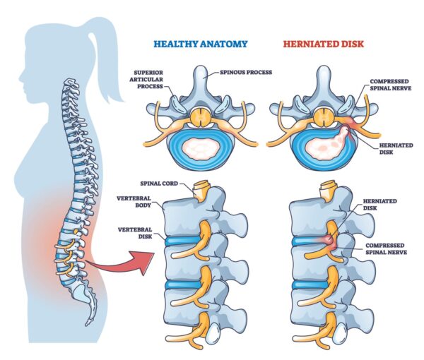 Types of Degenerative Disc Disease | Osteopath In London | MHV Clinic