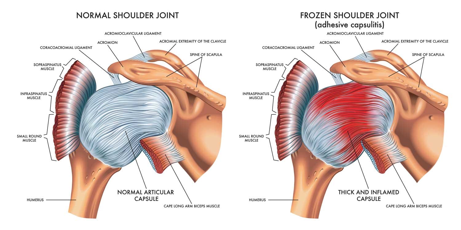 Frozen shoulder treatment london MHV Clinic