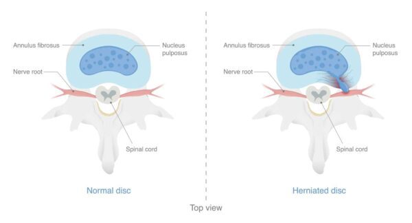 Slip Disc Statistics Causes of Slipped Disc | Osteopath In London | MHV Clinic