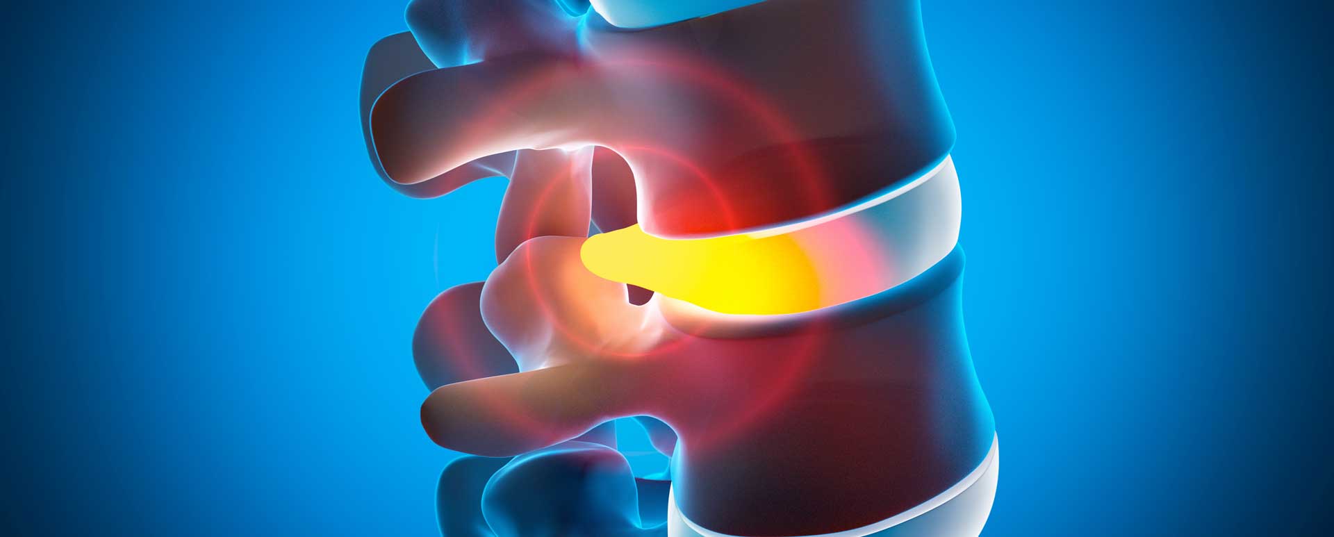 Slipped disc Osteopath