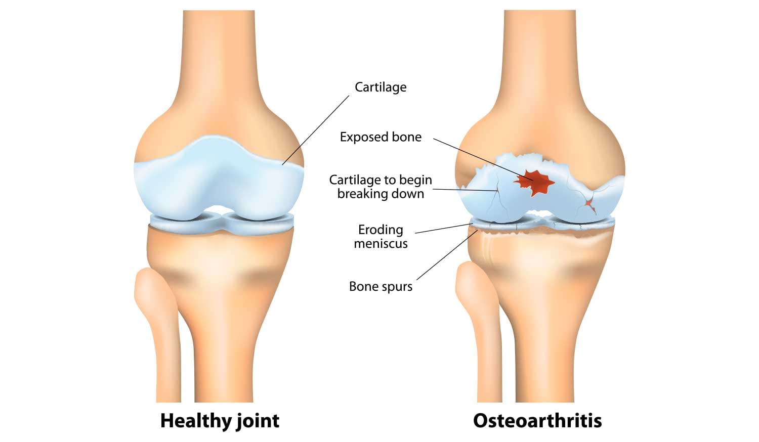 osteoarthritis an autoimmune disease benefits treatment
