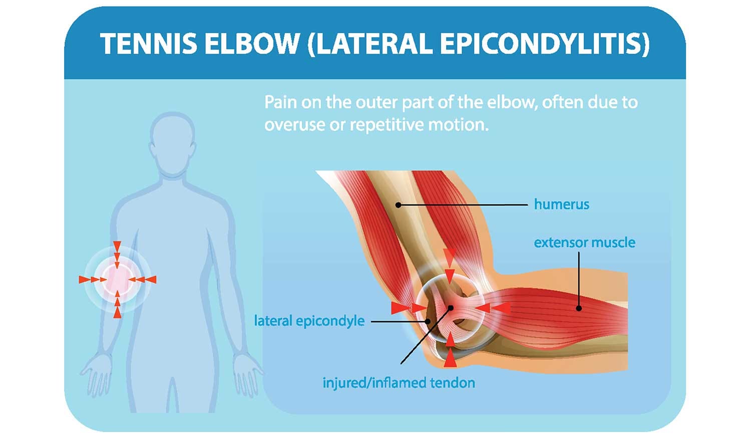 Common Elbow Injuries Causes