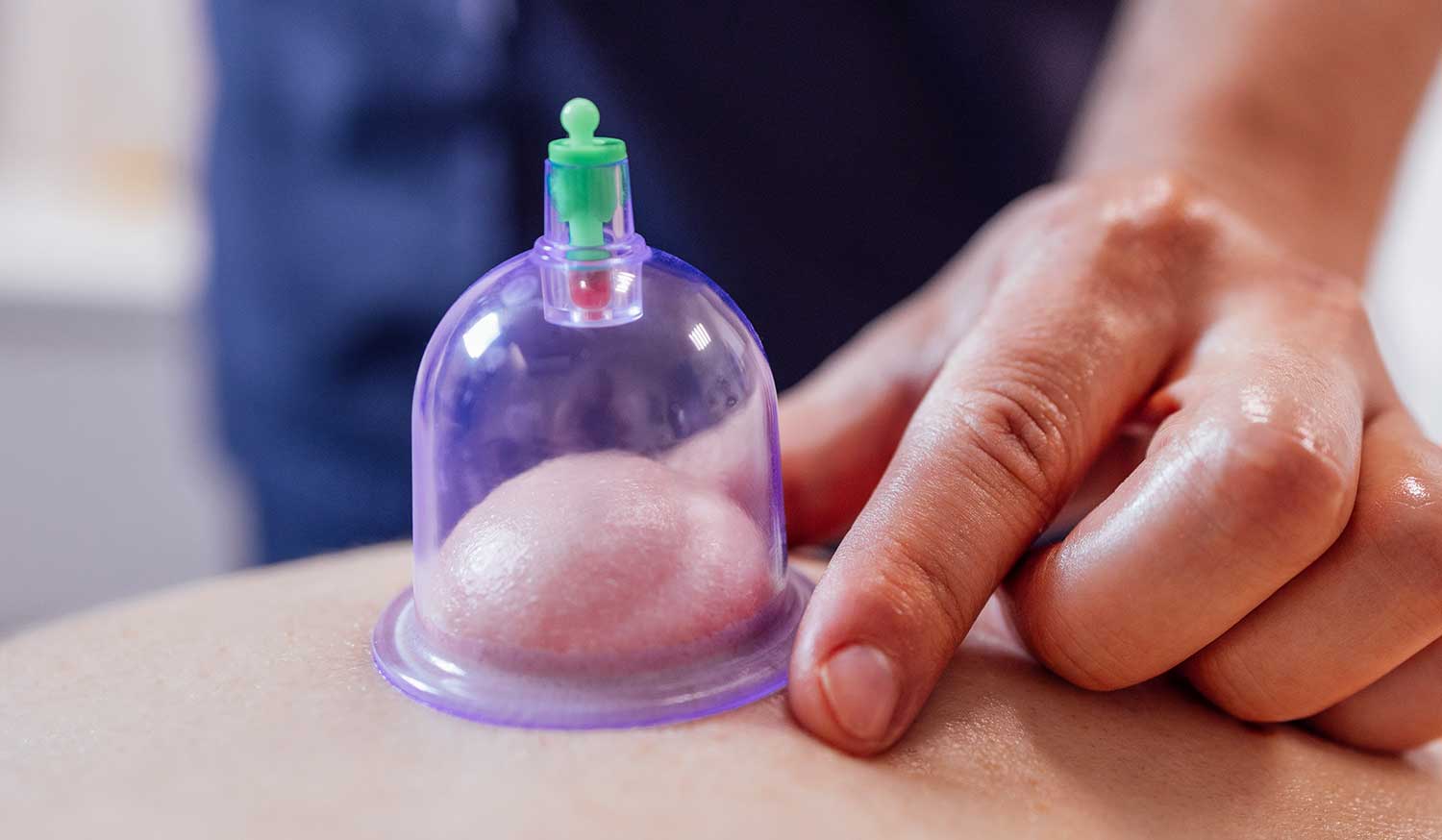 cupping for back pain