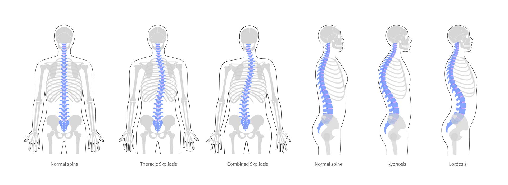 osteopathic scoliosis treatment in london