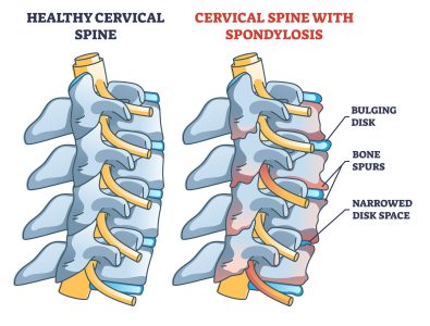 Cervical spondylosis problem compared with healthy spine