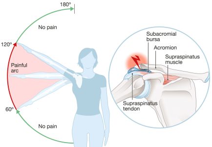 Shoulder Impingement Syndrome​ shoulder pain treatment by osteopaths in london