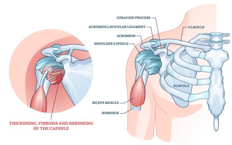 frozen shoulder syndrome treatment and pain relief in london