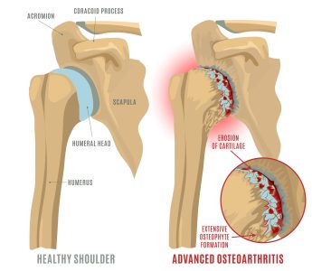 shoulder arthritis shoulder pain treatments london uk